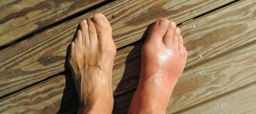 An image of swollen feet